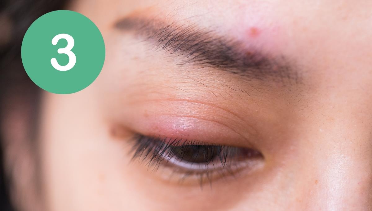 Los 3 mejores trucos para tratar un orzuelo en el ojo